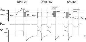 Methods for measuring distending pressure (DP) in volume control mode (DPst VC) and in pressure support mode: static (DPst PSV) and dynamic (△PL,dyn). Representation of the curve corresponding to airway pressure (Pva), muscle pressure (Pmus) and flow over time. In VC mode with constant flow, an inspiratory pause evidences the plateau pressure (Pplat), which represents the elastic rebound pressure of the respiratory system. As there is no inspiratory effort (Pmus = 0), the difference between Pplat and PEEP is the DP. Transpulmonary pressure in PSV depends on both pressure support (PS) and on the component of Pmus; an inspiratory pause allows us to evidence this effort, by raising the pressure curve to a value greater than the configured value: this is the Pplat, and its difference with PEEP is DP., In dynamic mode, △PL,dyn is estimated by summing PS to −2/3 occlusion pressure (6) (Pocc). Both methods are inter-correlated, with △PL,dyn always being (since it includes the resistive component of the respiratory system). On the other hand, PMI is also represented, being Pplat – (PS + PEEP), and constituting an indicator of inspiratory effort, together with P0.1, which is the pressure measured in the first 100 ms of inspiration and reflects the intensity of respiratory center demand. Note: Pocc is always ≤0 cmH2O (negative with respect to basal).