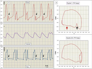 (A) Flow, volume and airway pressure (Paw) versus time. (B) Flow-volume loops (F/V). The flow and Paw signals evidence double-cycling 2–3, 3–4 and 8–9. The rest of the cycles show the usual findings of reverse trigger and/or early closure of inspiration, long vertical arrows in cycles 1, 6 and 7. The F/V loop of cycle 1 and 2–3 shows the same findings of the flow-time curve, though magnified. The loops moreover show the quite typical expiratory wavy pattern of active expiration, small red arrows.