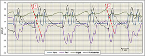 Recording of the airway (Paw), esophageal (Pes), gastric (Pgas) and transalveolar (Pt-alveolar) pressure signals. In the Pgas signal we can see the presence of active expiration, and how its release generates the start of the mechanical cycle, followed by effort of the inspiratory muscles as evidenced in Pes. The disappearance of the stimulus generated by active inspiration causes early closure of inspiration and makes the inspiratory effort more manifest, simulating reverse trigger. The vigorous effort on the part of the patient generates Pt-alveolar in excess of 30 cmH2O, causing lung overdistension and hyperinsufflation.