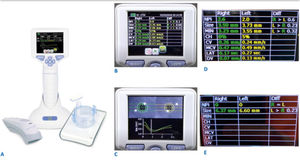Quantitative pupillometry. A) NPi-200 pupillometer. B) Pupillometry parameters, and measurments. C) Videorecording or pupillary examination. D) Pupillometry of a patient after cardiac arrest within the first 24 hours. E) Pupillometry with NPi of 0 in the same patient within 48 hours after cardiac arrest who later progresses into brain dead.