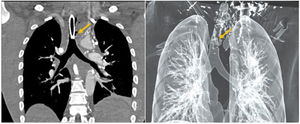 CT scan and 3D reconstruction image.