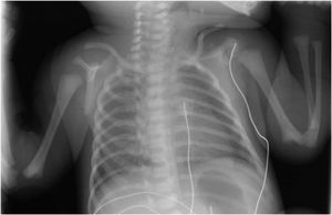 Posterior-anterior chest x-ray. No radiographic signs of pneumothorax found.