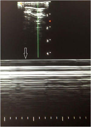 Lung ultrasound in M mode. “Bar code”, “stratosphere” or «seashore» sign.