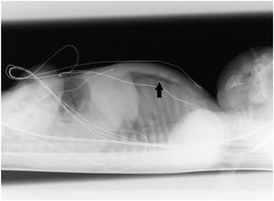 Lateral chest x-ray with horizontal beam. Bilateral anterior pneumothorax.