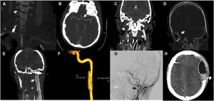 Radiographic aspects of patients with traumatic cerebrovascular lesion. A: dissection of right vertebral artery with rosary-like pattern and good distal flow (Denver type i). B: dissection of left supraclinoid internal carotid artery, filiform flow (Denver type iv). C: thrombosis of transverse venous sinus and right jugular vein. D: venous thrombosis of right sigmoid sinus. E: dissection of left carotid artery with development of pseudoaneurysm (Denver type iii). F: arteriography with 3D reconstruction of pseudoaneurysm (3 cm of longitudinal axis) in the left carotid artery postbulbar extracranial segment. G: dissection of postbulbar extracranial segment with presence of 2 pseudoaneurysms in the right internal carotid artery. H: hyperacute epidural hematoma after starting anticoagulation therapy.