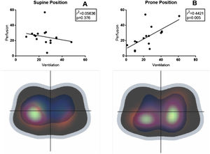 Regional distribution of ventilation and perfusion in the supine (A) and prone (B) position. Solid lines are regression lines between ventilation and perfusion at both positions. Distributions are expressed as a percentage of the regional variation (quadrants).
