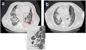 Macklin effect in a COVID-19 patient with ARDS subjected to IMV. The lung parenchyma window of the thoracic CT scan [a] shows a lineal accumulation of air adjacent to the bronchovascular sheath of the left upper lung lobe (the black arrow indicates the Macklin effect). [b] Appearance of pneumothorax days later.
