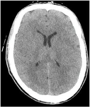 Cerebral CT scan.