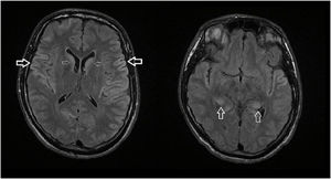 Cerebral MRI, Flair sequence.