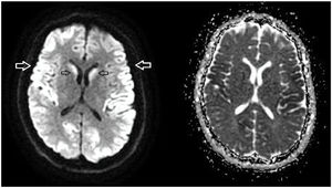 Cerebral MRI, diffusion sequence and ADC map.