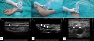 Ultrasound and clinical images with linear transducer (13-6 MHz) position corresponds to each other in upper and lower panel. White arrow showing vessel course and location of artery. A) Radial artery in in-plane view, B) dorsalis pedis artery in in-plane view, C) femoral artery in out-of-plane view.