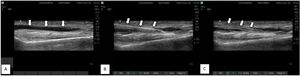 Ultrasound image with linear probe (13-6 MHz) showing radial artery cannulation procedure. A) Pre-procedural Scan- White arrow showing radial artery course B) Procedural Scan- White arrow showing radial artery cannulation with 20 G cannula with needle in situ. C) Post-procedural scan- White arrow showing catheter position after removal of needle.