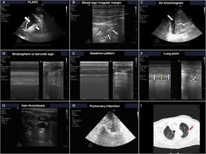 The most frequent findings in patients with acute respiratory failure. A) Images of PLAPS, showing hypoechoic zones delimiting a poorly defined margin (small arrow) and pleural effusion (large arrow). B) Subpleural consolidation comprising a hypoechoic zone in contact with the pleural line surrounded by an irregular hyperechoic margin (shred sign). C) Air bronchogram showing hyperechoic lines (small arrow) in the context of lung hepatization, surrounded by adjacent pleural effusion (large arrow). D) Bar code pattern (stratosphere sign) in M mode, corresponding to pneumothorax. E) Seashore pattern in a lung with preserved pleural sliding. F) M mode positioned (left) in the zone corresponding to the lung point (arrow, image at right). Oscillation is observed of the seashore (white arrows) and barcode patterns (yellow arrows) in relation to the inspiratory and expiratory phases. G) Thrombus in the internal jugular vein, manifesting as a hyperechoic image occupying most of the vascular lumen. H) Pulmonary infarction: hypoechoic zone, containing a hyperechoic image (obtained with a low-frequency probe), corresponding to the bronchial tree. I) Pulmonary infarction zone (red arrow) in the lung computed tomography scan of the same patient.