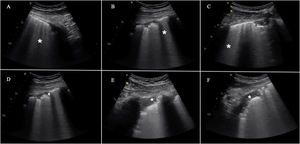 The most frequent findings in patients with acute respiratory failure associated with COVID-19. This includes the presence of B lines in all their possible forms, even to the point of forming a “white lung” image. They may arise from the pleural line or from small peripheral consolidations. A) Separated B lines. B) Coalescent B lines. C) “White lung”. D) Irregular and fragmented pleural line. E) and F) Subpleural consolidations.