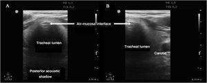 Image of the trachea. A) Normal view centered on the trachea at the height of the suprasternal notch. B) Normal view lateralized to the left, showing the carotid artery.