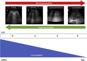 Ultrasound patterns of lung aeration. A: A lines pattern, normal aeration; B: B ≥ 3, separated B lines indicating moderate loss of aeration; C: coalescent B lines indicating severe loss of aeration; D: tissue or consolidation pattern, indicating a complete loss of aeration. Each pattern produces a score for generating the lung ultrasound score (LUS).