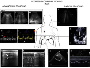 Main ultrasound explorations used for diagnosing the cause of mechanical ventilation weaning failure. Division is made into explorations requiring a basic training in ultrasound and those requiring advanced training. A) Pulmonary ultrasound with the detection of an increase of ≥6 B lines during the spontaneous breathing trial (SBT) for the diagnosis of weaning-induced pulmonary oedema (WIPO). B) Echocardiography, four-chamber apical plane imaging for the study of systolic function of the left ventricle and its structural alterations (hypertrophy, dilatation, severe mitral valve insufficiency). C) Diaphragm excursion study in two-dimensional imaging (see video in electronic supplementary material). D) Diaphragm excursion study in M mode. Note the wave generated by diaphragm excursion with respiratory motion. An excursion of <10 mm is considered to be pathological. E), F) and G) Images used to calculate the lung ultrasound score (LUS), as described in the text. H) Study of diastolic function, pulsed Doppler view of transmitral flow, showing the early (E, white arrow) and late filling waves (A, red arrow). I) Study of diastolic function, tissue Doppler view of the lateral mitral annulus, showing the e' wave (white arrow). J) Image of the diaphragm in two-dimensional mode in the appositioning zone over the ninth intercostal space. The diaphragm is the structure located between the two hyperechogenic lines identified with the arrows (upper pleura, lower diaphragm; video and details in electronic supplementary material). K) Image in M mode for studying diaphragmatic thickening, identifying maximum thickness in inspiration and minimum thickness in expiration.