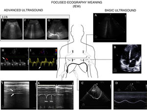 Main ultrasound explorations used for diagnosing the cause of mechanical ventilation weaning failure. Division is made into explorations requiring a basic training in ultrasound and those requiring advanced training. A) Pulmonary ultrasound with the detection of an increase of ≥6 B lines during the spontaneous breathing trial (SBT) for the diagnosis of weaning-induced pulmonary oedema (WIPO). B) Echocardiography, four-chamber apical plane imaging for the study of systolic function of the left ventricle and its structural alterations (hypertrophy, dilatation, severe mitral valve insufficiency). C) Diaphragm excursion study in two-dimensional imaging (see video in electronic supplementary material). D) Diaphragm excursion study in M mode. Note the wave generated by diaphragm excursion with respiratory motion. An excursion of <10 mm is considered to be pathological. E), F) and G) Images used to calculate the lung ultrasound score (LUS), as described in the text. H) Study of diastolic function, pulsed Doppler view of transmitral flow, showing the early (E, white arrow) and late filling waves (A, red arrow). I) Study of diastolic function, tissue Doppler view of the lateral mitral annulus, showing the e