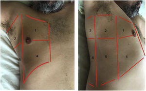 Areas for ultrasound exploration of the thorax. The anterior area comprises the space delimited between the sternum (medial), the anterior axillary line (lateral), the clavicle (cranial) and the diaphragm (caudad). The lateral area comprises the space delimited by the anterior axillary line (medial), the posterior axillary line (lateral), the axilla (cranial) and the diaphragm (caudad). The posterior area comprises the space delimited by the posterior axillary line (lateral), the paravertebral line (medial), the margin of the trapezius muscle (cranial) and the diaphragm (caudad). Each of them in turn can be subdivided into a superior zone and an inferior zone, resulting in 6 echographic exploration areas.
