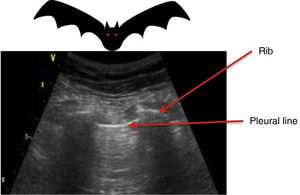 The “Bat sign”. The “bat sign” refers to the image formed by the pleural line between the acoustic shadow generated by two consecutive ribs on placing the ultrasound probe in a longitudinal position.