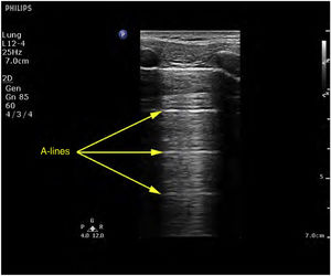 A-lines. A line pattern, constituting horizontal hyperechogenic artifacts that are simply a repetition of the pleural line.
