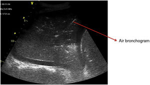 Consolidation pattern. Image showing an alveolar condensation pattern with air bronchogram.