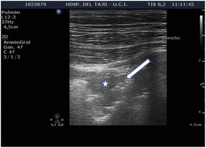 The “Shred sign”. Subpleural condensation image (star). A central hypoechoic zone is observed, surrounded by a poorly defined hyperechoic margin, in contact with the pleura (arrow).