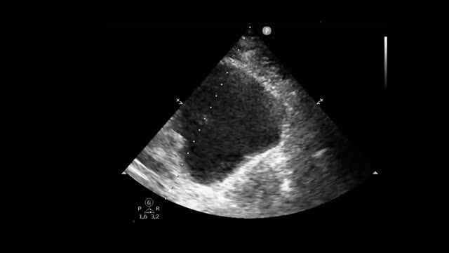 Abdominal ultrasound and VExUS score in critical care | Medicina Intensiva