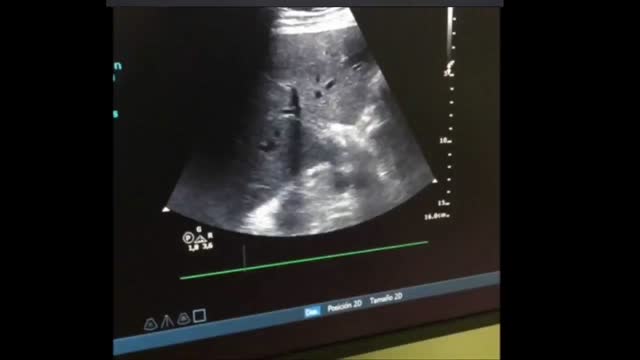 Abdominal ultrasound and VExUS score in critical care | Medicina Intensiva