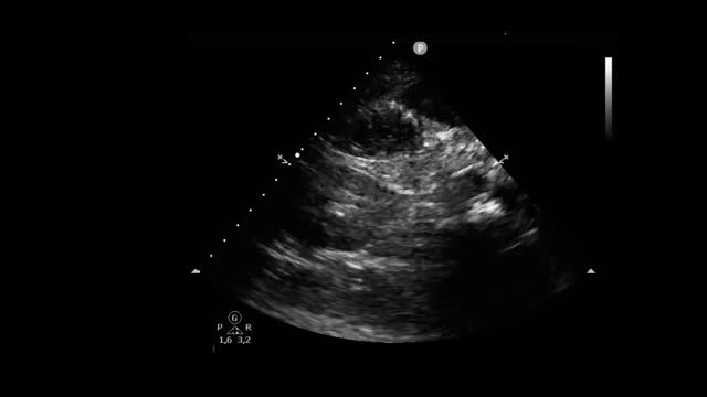 Abdominal ultrasound and VExUS score in critical care | Medicina Intensiva