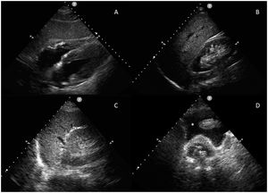 FAST study. Ultrasound views: subcostal (A), right upper quadrant (B), left upper quadrant (C) and suprapubic (D). +: Bladder catheter balloon. *: Free fluid.