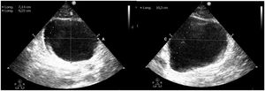 Bladder evaluation. Calculation of bladder volume. Width and depth are measured in the transverse view (A and B), and the superior-inferior dimension or height is measured in the longitudinal plane (C).