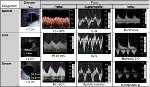 Venous excess ultrasound score (VExUS) for the classification of venous congestion. IVC: Inferior vena cava; PI: Pulsatility index; S: Systole; D: Diastole. Grade 0: IVC < 2 cm, normal patterns; Grade 1: IVC > 2 cm and mild congestion pattern; Grade 2: IVC > 2 cm and one organ with severe congestion pattern; Grade 3: at least two organs with severe congestion pattern. Renal flow often includes the artery (positive, always pulsatile) and vein (under zero line), as they run parallel.