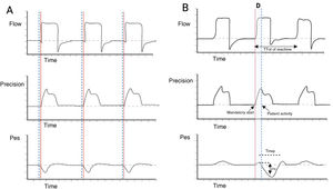 Schematic description of reverse triggering. Panel A) Spontaneous ventilation in VC mode is observed, where the start of patient effort (dotted blue lines) precedes the start of the mandatory ventilation cycle (solid red line). Panel B) RT asynchrony is observed, showing the out-of-phase occurrence of patient effort (Pes negative deflection and dotted blue line) with respect to the start of the mandatory ventilation cycle (solid red line). Abbreviations. VC: volume control; RT: reverse triggering; D: out-of-phase; Pes: esophageal pressure.