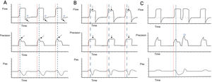 Detection of reverse triggering by visual inspection. Panel A) Spontaneous ventilation in VC mode is observed, with the appearance of RT of middle activation and late relaxation, with 1:1 pattern; the red lines indicate the start of mandatory ventilation, and the broken blue lines indicate the response of the diaphragm. In the flow-time curve, the solid arrows indicate amputation of the expiratory flow; the star indicates attempted flow positivity during the expiratory phase. In the pressure-time curve, the broken arrows indicate the drop in peak pressure. Panel B) Ventilation in PC mode is observed, with the appearance of RT of middle activation and late relaxation, with 1:1 pattern; the red lines indicate the start of mandatory ventilation, and the broken blue lines indicate the response of the diaphragm. In the flow-time curve, the broken arrows show an increase in flow during deceleration; in the pressure-time curve, the solid arrows show a slight drop in airway pressure. Panel C) Ventilation in VC mode is observed, with the appearance of RT of middle activation and late relaxation, inducing double cycling; the red lines indicate the start of mandatory ventilation, and the broken blue lines indicate the response of the diaphragm. In the pressure-time curve, the star indicates the double cycling. Abbreviations. VC: volume control; RT: reverse triggering; PC: pressure control; Pes: esophageal pressure.