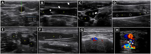 Ultrasound-guided vascular cannulation. A) Preprocedural assessment of a peripheral vein for ultrasound-guided cannulation. The anteroposterior diameter of the vein (continuous yellow line, Distancia 2) and distance from the vein to the skin (continuous green line, Distancia 1) are measured. B) In-plane cannulation of the internal jugular vein (v); arrows, needle shaft; arrowhead, needle tip. C) Out-of-plane cannulation of the internal jugular vein (v); a, common carotid artery; arrow, needle. D) The guidewire is observed in the vein lumen (arrows) before placement of a long catheter in the basilic vein (e.g., midline catheter); v, vein. E) A peripheral venous catheter (arrow) is observed in the lumen of a deep vein of the arm (short axis); v, brachial veins; a, brachial artery. F) A peripheral catheter (arrows) is depicted in the lumen of a superficial vein in the long axis; v, vein. G) Subperiostial flow is observed on color Doppler after intraosseous needle insertion. H) Pseudoaneurysm as a complication of femoral arterial catheterization; black arrows, pseudoaneurysm cavity; white arrows, pseudoaneurysm neck; a, common femoral artery; v, common femoral vein.