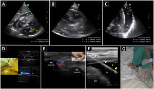 Ultrasound-guided pericardiocentesis. A) Subcostal 4 chamber view. B) Parasternal long-axis view. C) Apical view. As noted, the optimal window to insert the needle is the apical, given the shorter distance to reach the pericardial space (continuous green line) and higher pericardial fluid thickness (continuous yellow line). RA, right atrium; RV, right ventricle; LA, left atrium; LV, left ventricle; RVOT, right ventricular outflow tract. Asterisks indicate pericardial effusion. Adapted from Blanco P, Figueroa L, Menéndez MF, Berrueta B. Pericardiocentesis: ultrasound guidance is essential. Ultrasound J. 2022;14(1):9. https://theultrasoundjournal.springeropen.com/articles/10.1186/s13089-022-00259-5. (CC-BY-4.0). D) Recognition of the left internal thoracic vessels along the left parasternal line (dotted white line) with a linear probe on two-dimensional and color Doppler imaging; s-sct, skin-subcutaneous tissue; m, intercostal muscle; r, rib; arrowhead, pleura; asterisks, internal thoracic vessels. E) Recognition of the intercostal vessels with a linear probe on color Doppler imaging. Real-time in-plane ultrasound-guided pericardiocentesis via intercostal approach (apical view) using a linear probe. The needle (arrows) is entirely observed in the pericardial space (asterisks); LV: left ventricle. G) Hemorrhagic fluid is freely evacuated from the pericardial space after catheter placement.
