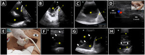 Ultrasound-guided thoracentesis. A) A simple pleural effusion (asterisks), diaphragm (d) and lung (L) are delineated using ultrasound. B) A complex pleural effusion (asterisk) is observed; d, diaphragm. C) The best fluid pocket for thoracentesis is selected by measuring the distance from the skin to the pleural effusion (asterisk) and the effusion depth; L, lung; d, diaphragm. D) The intercostal vessels are delineated before cannulation using a linear transducer and color Doppler. E) The insertion site is marked on the skin. F) Dynamic ultrasound guidance for thoracentesis. Arrows, needle shaft; arrowhead, needle tip; asterisk, pleural effusion; L, lung. G) The guidewire (arrows) is observed within the pleural effusion (asterisks); d, diaphram. H). A central catheter (arrows) is observed within the pleural effusion (asterisks); L, lung.