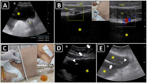 Ultrasound-guided paracentesis. A) Ascites is observed (asterisk), and the distance from the skin to the effusion and to a bowel loop (b) is obtained. B) The inferior epigastric vessels (boxes) are delineated into the abdominis rectus sheath using a linear probe on two-dimensional and color Doppler imaging; s, skin; sct, subcutaneous tissue; m, rectus abdominis muscle; asterisk, ascites. C) The insertion site is marked on the skin, and puncture is performed under static guidance. D) Real-time ultrasound-guided paracentesis; arrows, needle shaft; arrowhead, needle tip; asterisk, ascites. E) A locking pigtail catheter is observed within the ascites (asterisks). The arrow indicates the body, whereas the arrowhead indicates the tip of the pigtail.