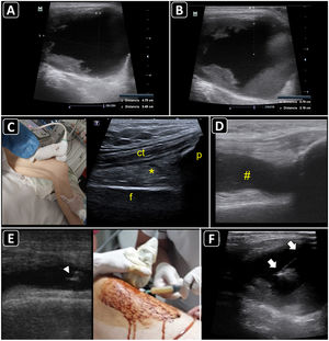 Ultrasound-guided aspiration of soft tissue collections and arthrocentesis. A) Soft tissue fluid collection is identified and measured. B) Distances are measured to estimate the needle depth of insertion and length to be used. C) Technique for finding the suprapatellar articular recess of the knee and its corresponding ultrasound images; p, patella; t, cuadriceps tendon; f, femur; asterisk, fat pad (articular recess). D) Knee effusion is indicated by the symbol #. E) Real-time ultrasound-guided arthrocentesis of the knee, obtaining a purulent fluid. The arrowhead indicates the bevel of the needle that reached the articular effusion. F) Real-time ultrasound-guided aspiration of soft tissue collection. The needle is indicated by arrows.