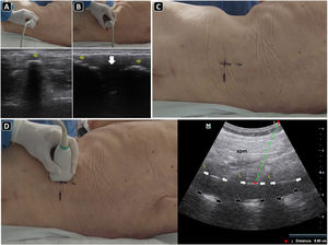 Ultrasound-guided lumbar puncture. A) With the linear transducer placed transversally over the midline of the lower back, the spinal processes (sp) are recognized and the skin marked with a pen. B) After rotating the transducer 90 degrees clockwise and placing it longitudinally over the midline of the lower back, the spinal processes (sp) are seen, and the interspinal space (arrow) is delineated, and the skin is marked with a pen. C) Intersecting the skin markings obtained in A) and B), the needle insertion site is marked with a pen. D) Parasagittal approach and the corresponding ultrasound image. To obtain this view, the transducer is slightly basculated to one side from the longitudinal midline view. In the ultrasound image, the spinal muscles (spm), laminae (L), posterior complex (white arrows), and posterior longitudinal ligament (black arrows) are well recognized. The distance to the posterior complex is measured (dotted green line), to approximate the needle depth of insertion during the lumbar puncture.