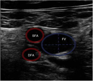 Femoral vascular ultrasound. Vascular ultrasound view and graphic representation of the circumference and diameter of the femoral vein (FV) and superficial (SFA) and deep femoral arteries (DFA).