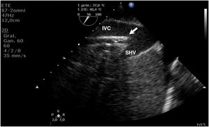 Transesophageal echocardiography (TEE) of femoro-jugular cannulation for VV ECMO. ECMO drainage cannula (arrow) at inferior vena cava (IVC) level and extremity at drainage level of the right suprahepatic vein (SHV).