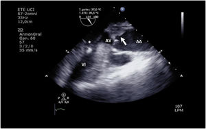 Transesophageal echocardiography (TEE) of thrombotic aortic valve in a patient with VA ECMO. Closed aortic valve (AV) with thrombus (arrow) at sinus of Valsalva level in a patient with VA ECMO and ventricular draining cannula.