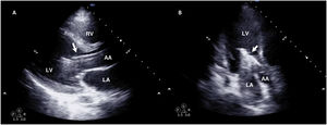 Transthoracic echocardiography (TTE) of Impella® in a patient with VA ECMO. Long-axis parasternal TTE (A) and three-chamber apical TTE (B) of Impella® (arrow) at left ventricle (LV) level.