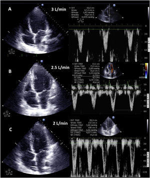 Echocardiographic evaluation of weaning in a patient with VA ECMO. Transthoracic echocardiography (TTE) and velocity-time integral (VTI) of the left ventricle outlet tract (LVOT) on reducing flow (A: 3 l/min, B: 2.5 l/min, C: 2 l/min) of VA ECMO. Note the increase in magnitude of VTI and consequently of stroke volume (SV) and cardiac output (CO).