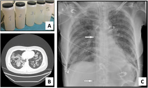 A. Characteristic fluid extracted during WLL, initially with a milky appearance and progressive clearing. B. High-resolution chest CT. Lung parenchyma with extensive ground-glass opacities and associated septal thickening (typical “crazy paving” pattern). C. Chest radiograph. Extensive bilateral alveolointerstitial infiltrates; ECMO cannulae (arrows) properly positioned, with separation >10 cm to minimize recirculation phenomenon.
