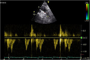 Pulsed-wave Doppler registry of the descending aorta while ventricular assist is being used with IABP.
