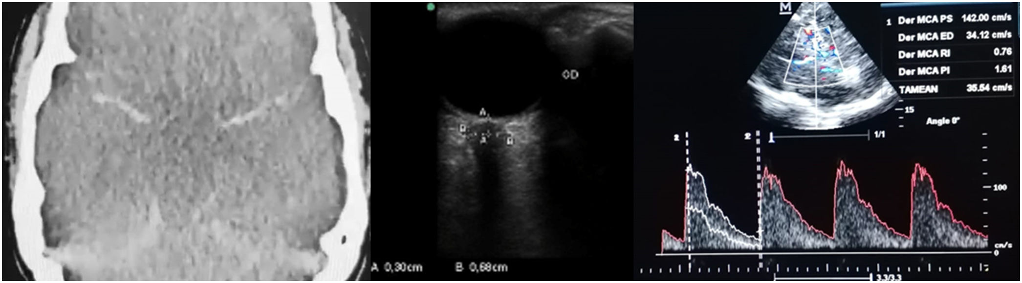 Transcranial sonography in the critical patient | Medicina Intensiva