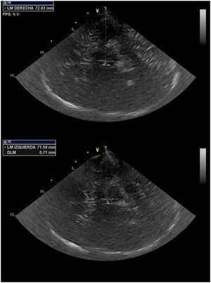 Determination of midline deviation after measuring the distance from the transducer to the third ventricle and applying the formula MLD=A-B/2.